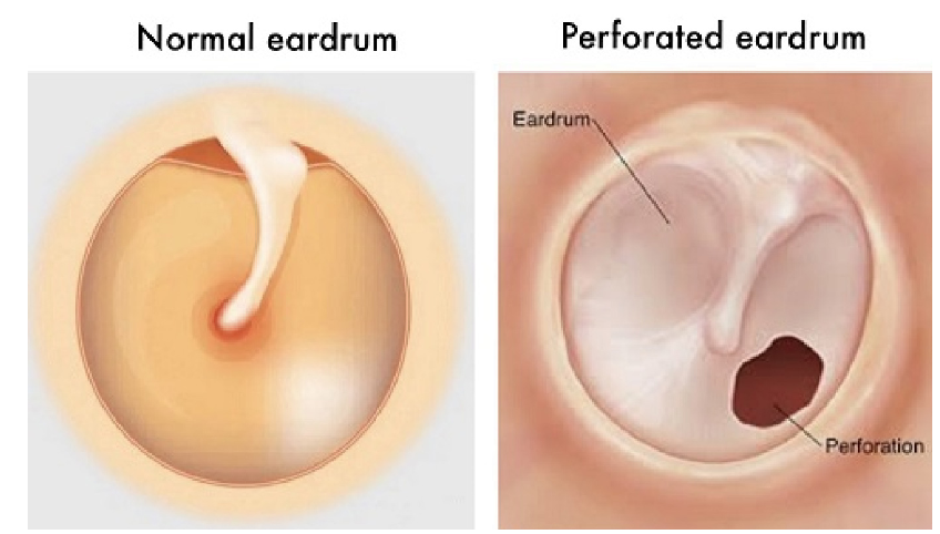 Perforated Ear Drum Perforated Ear Drum
